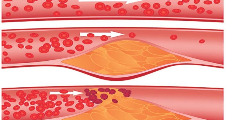 Кардіолог назвала категорії людей, яким потрібно перевіритися на атеросклероз