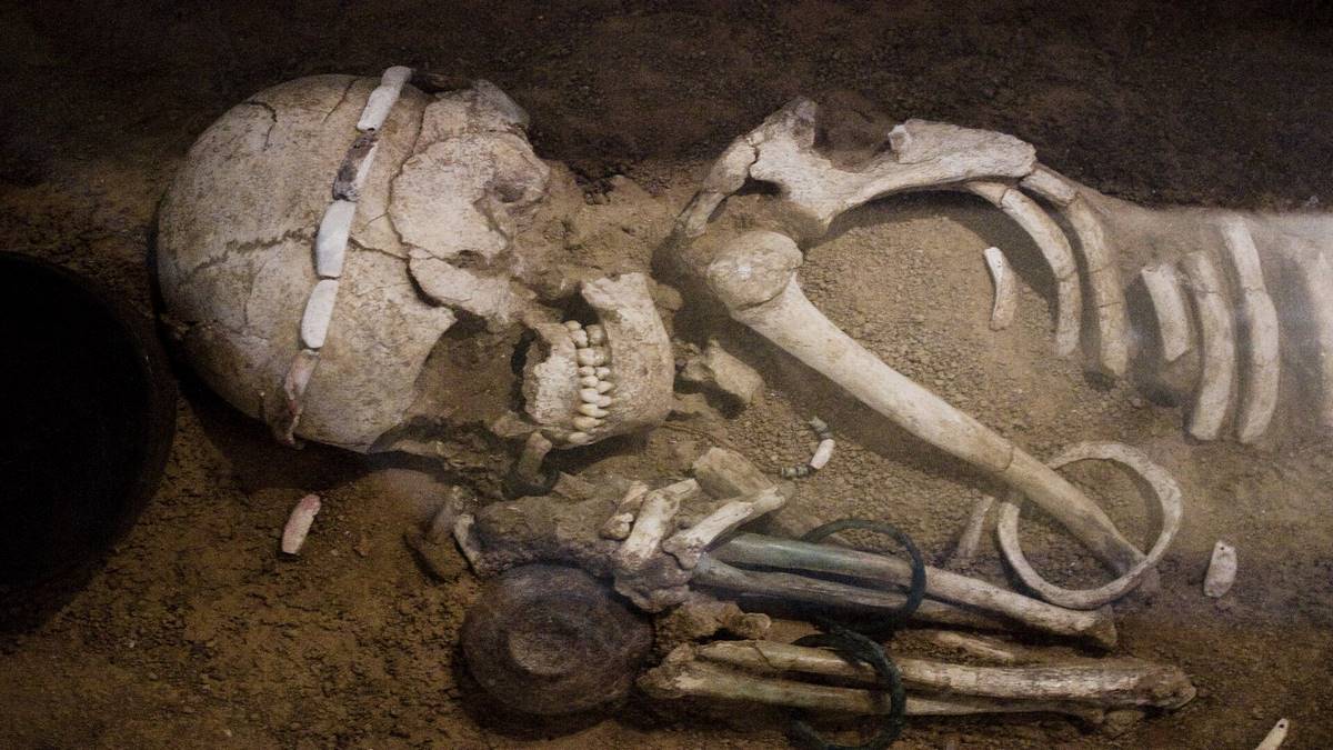 Зубний камінь середньовічних скелетів розкрив лікування прокази ртуттю